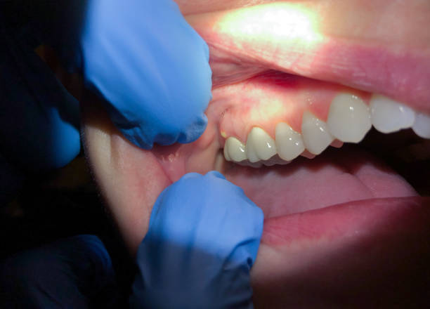 Best Dentist for Tooth Abscess  in Mehlville, MO
